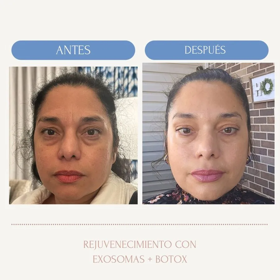 Before and after rejuvenation with exosomes and Botox